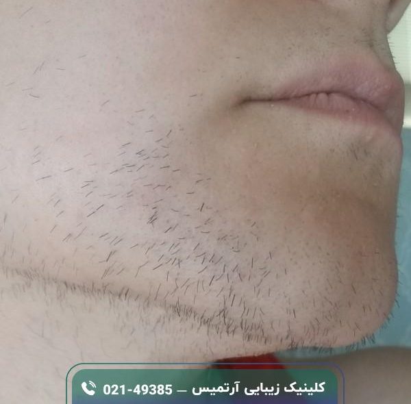 الکترولیز موهای زائد؛ روش، مزایا، معایب