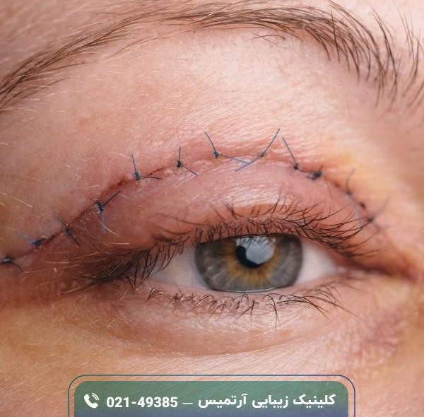 بلفاروپلاستی چیست؛ کاربرد، عوارض و قیمت جراحی افتادگی پلک