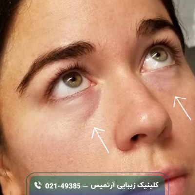 عوارض فيلر زير چشم؛ لیست عوارض + راهکار عوارض فيلر زير چشم؛ لیست عوارض + راهکار