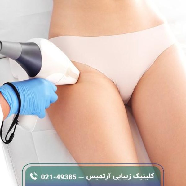 لیزر موهای زائد واژن (بیکینی)؛ معرفی، مزایا، معایب و مراحل لیزر موهای زائد واژن (بیکینی)؛ معرفی، مزایا، معایب و مراحل