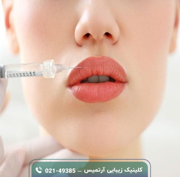 فیلر لب چیست؛ انواع، مراقبت ها و هزینه فیلر لب چیست؛ انواع، مراقبت ها و هزینه