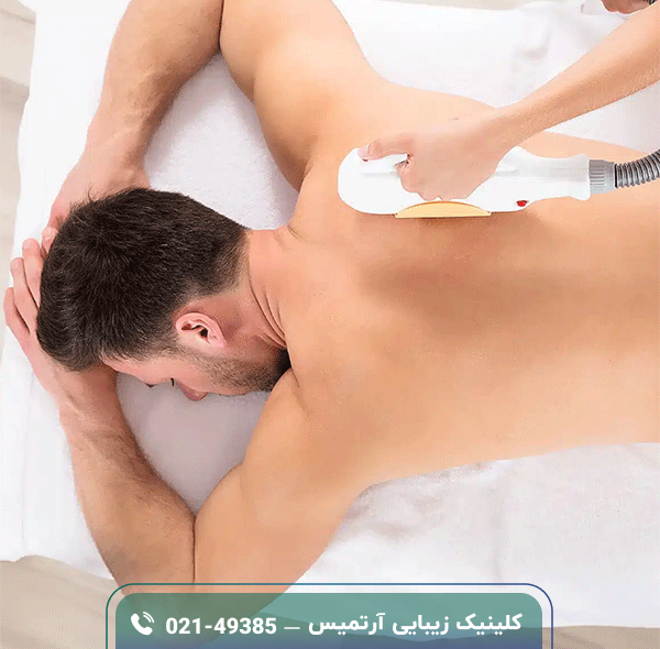 لیزر موهای زائد مردان؛ مزایا، معایب و هزینه لیزر موهای زائد مردان؛ مزایا، معایب و هزینه